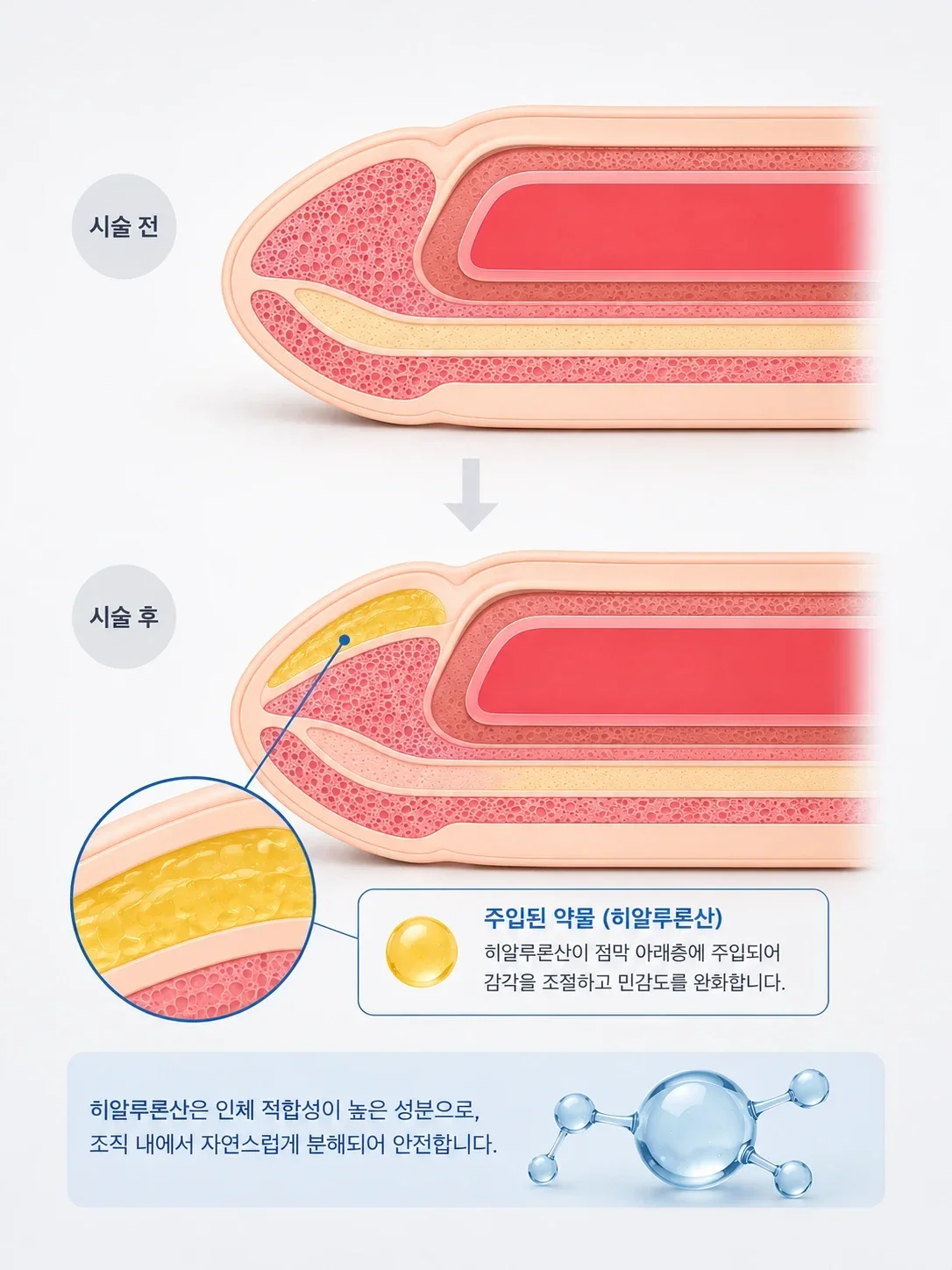 필러 귀두 확대술