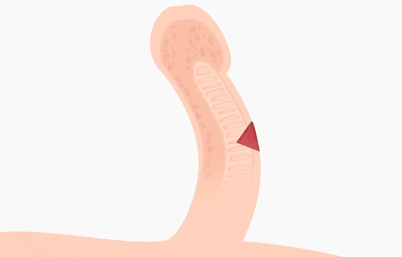 백막성형술