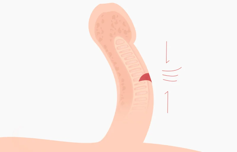 백막성형술