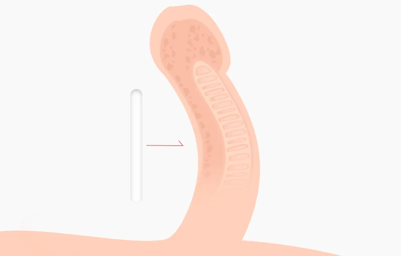 음경보형물 삽입술
